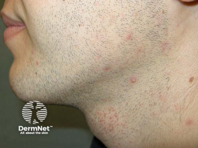 DermNet® - Pseudofolliculitis Barbae Image