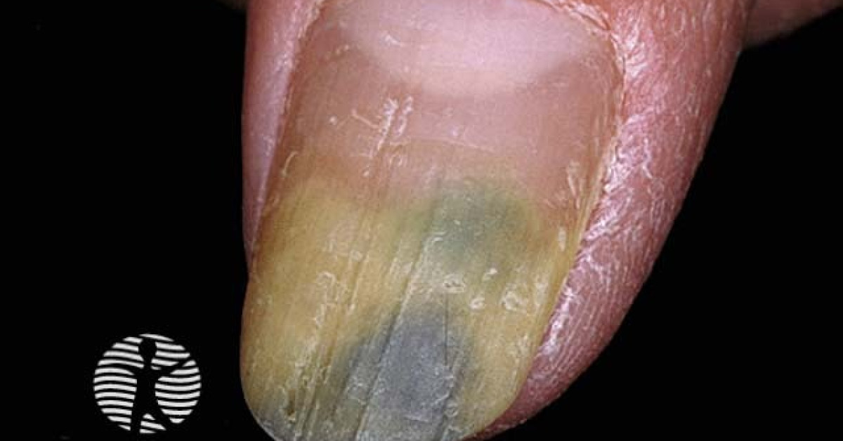 Pseudomonas Nail Image Pseudomonas Nail Image