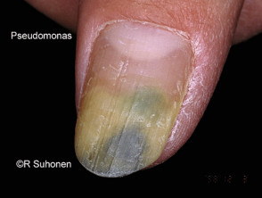 Thyroid acropachy  Nail and Distal Digit