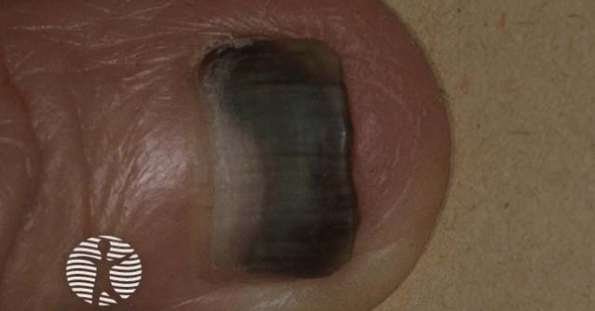 Pseudomonas stained nail image