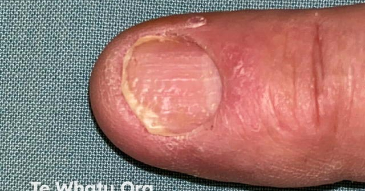 Nail psoriasis image