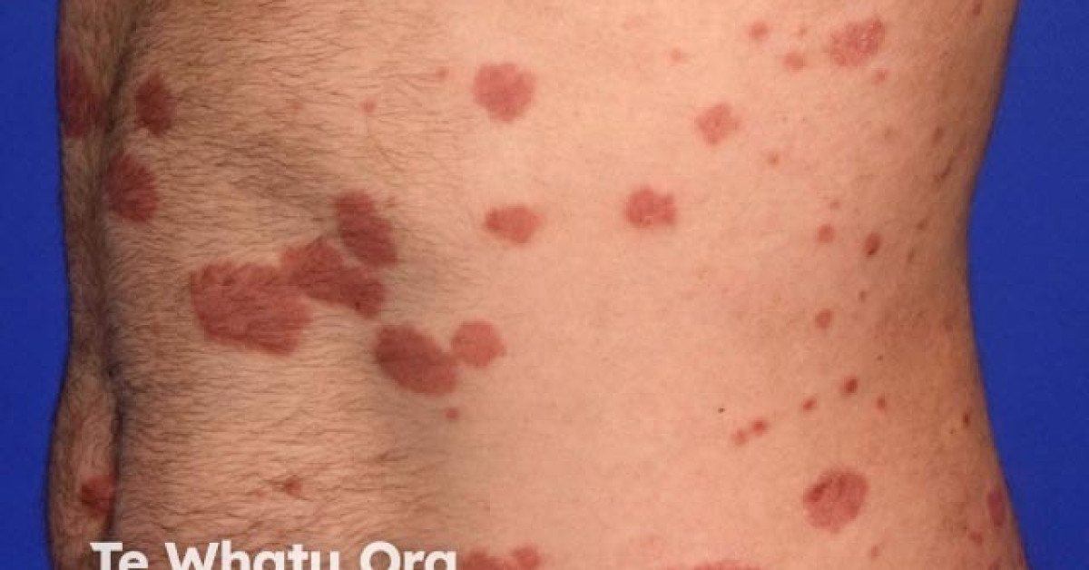 DermNet® - Chronic Plaque Psoriasis Image