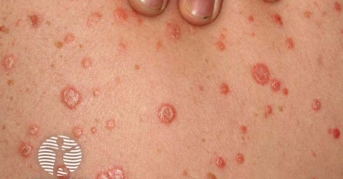 Guttate psoriasis image