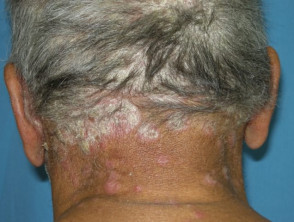 Scalp and neck psoriasis