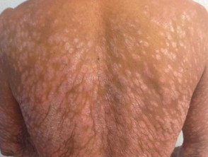 Severe psoriasis affecting back