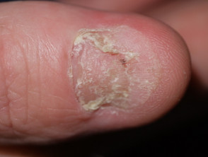 psoriatic nail dystrophy
