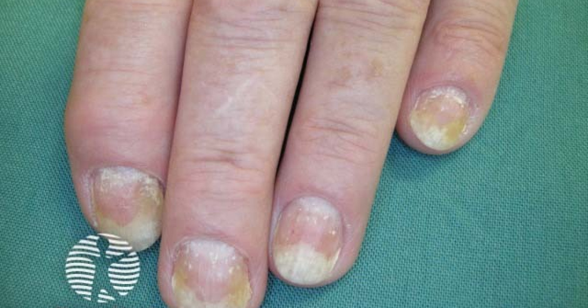 DermNet® - Psoriatic nail dystrophy image