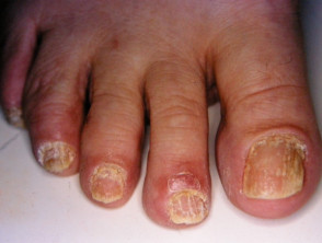 Psoriatic nail dystrophy