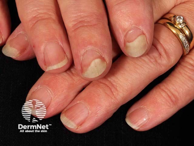 Psoriatic nail dystrophy