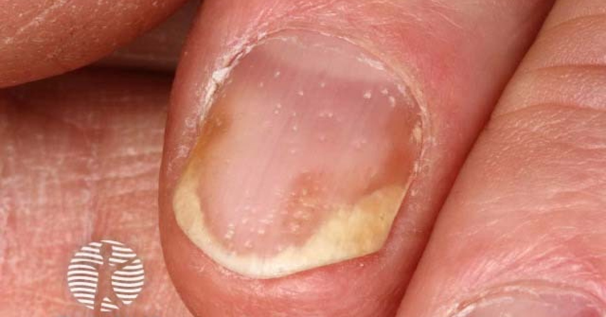 Psoriatic nail dystrophy image