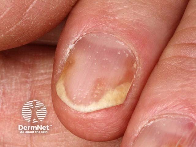 Onycholysis in psoriatic nail dystrophy