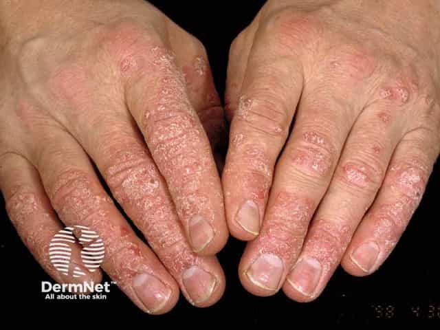Psoriasis of hands
