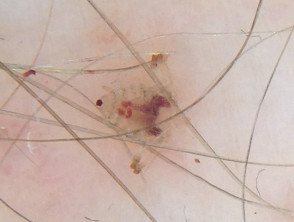 Pubic Lice Pediculosis Dermnet