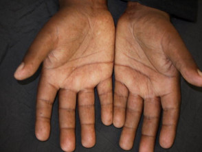 Puffy hand in early systemic sclerosis