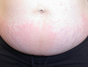 Polymorphic Eruption Of Pregnancy Dermnet Nz