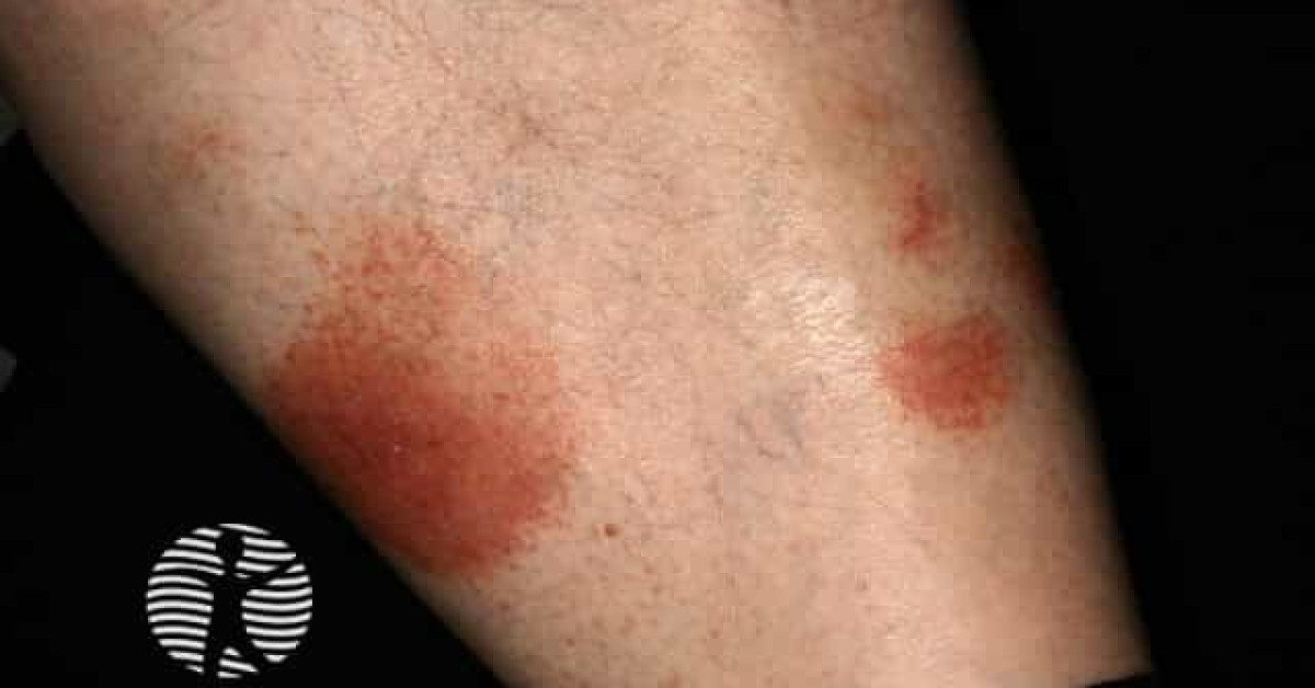 Pigmented purpuric dermatitis image