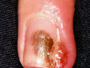 Pyogenic granuloma, nail
