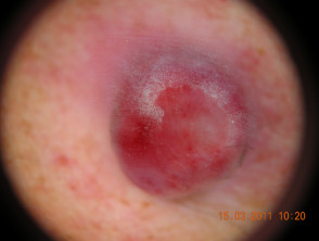 Pyogenic granuloma