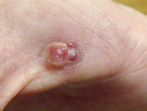 Pyogenic granuloma of the hand