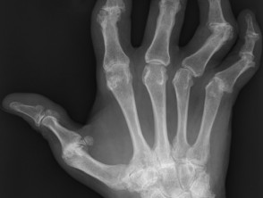 X-ray of right hand affected by psoriatic arthritis