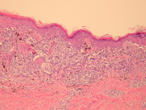 Radial growth phase superficial spreading melanoma