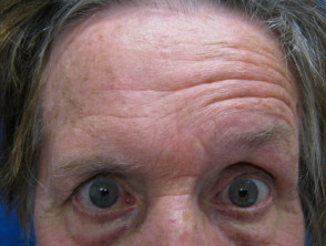 Ramsay Hunt syndrome: facial palsy