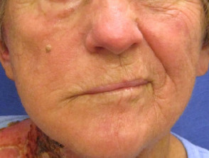 Ramsay Hunt syndrome: facial palsy