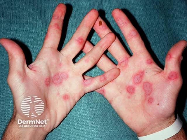 Cutaneous adverse reaction to anticonvulsant, erythema multiforme target lesions