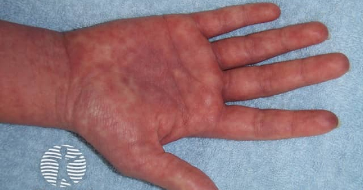 Morbiliform Rash Diffuse Cutaneous adverse reaction to anticonvulsant, morbilliform image