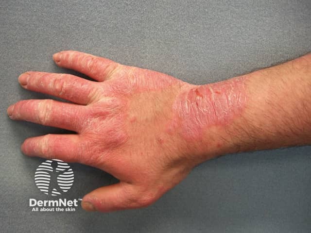 Dermatitis on hands