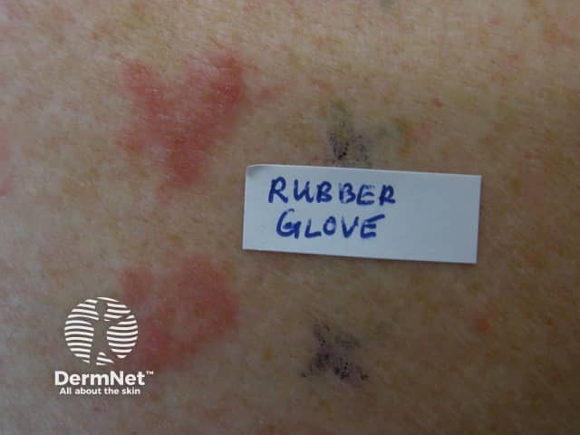 Patch tests positive to rubber glove