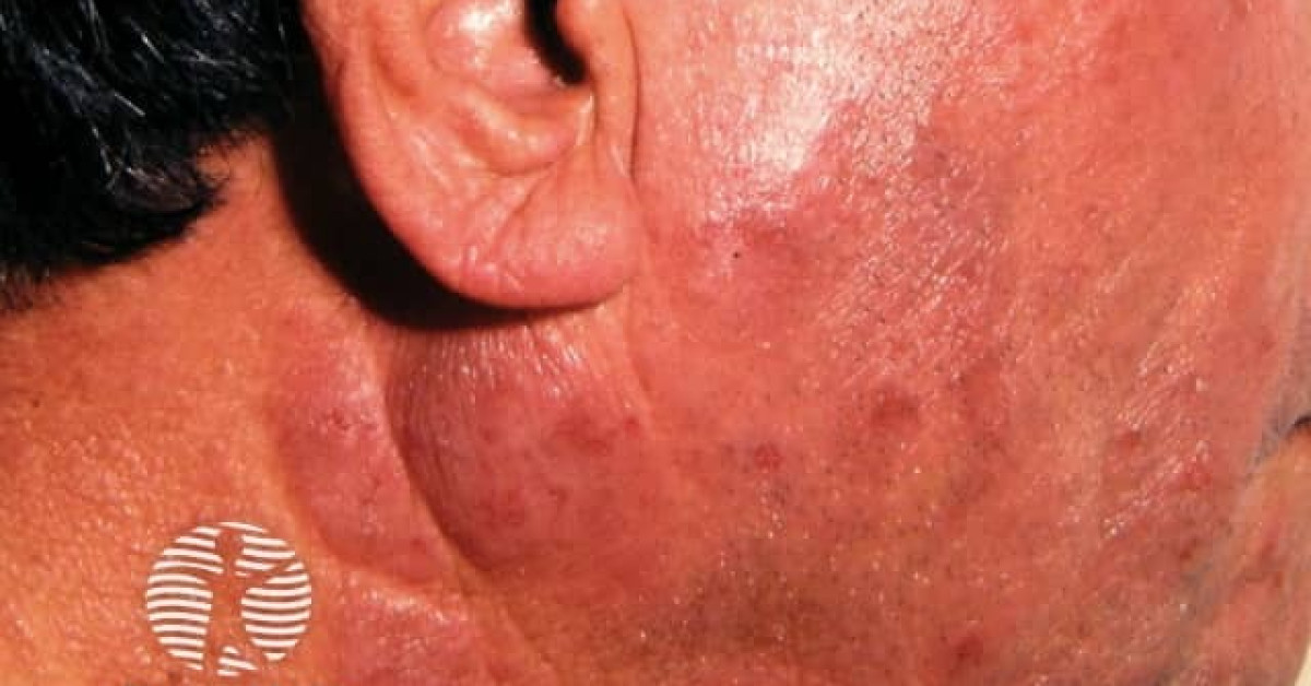 icd 10 code for chronic actinic dermatitis