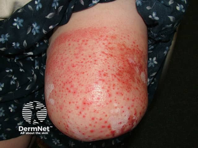 Acute dermatitis affecting amputation stump