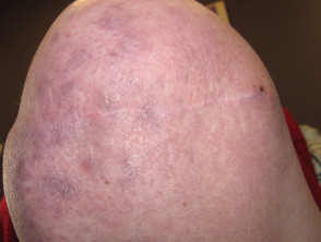 Skin problems affecting an amputation stump
