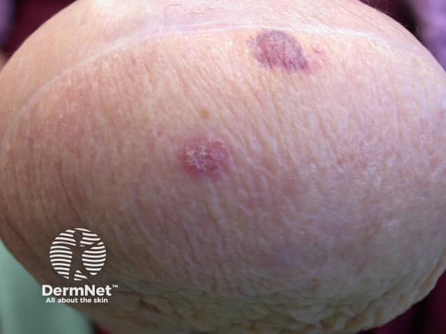 Intraepithelial carcinoma on amputation stump