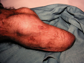 Skin cancer arising on limb of amputee