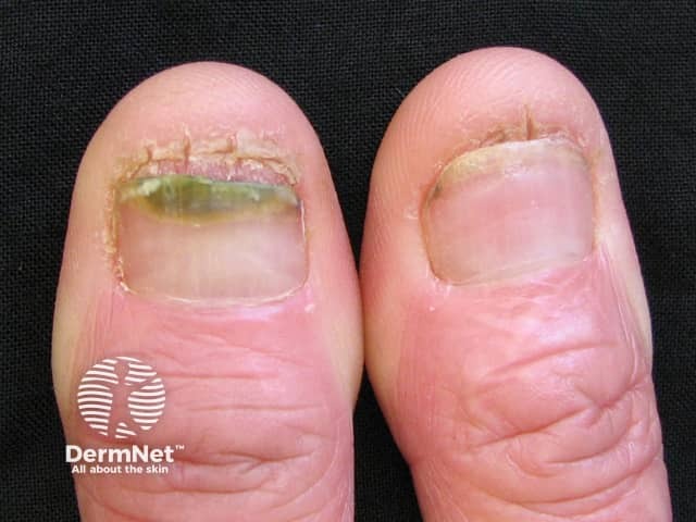 Candida nail infection