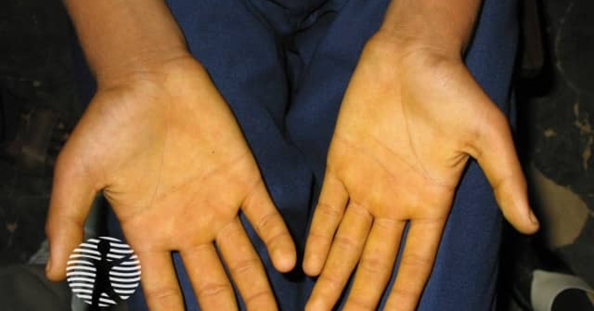 Right Hand Yellow Carotenaemia from antiepileptic drug image