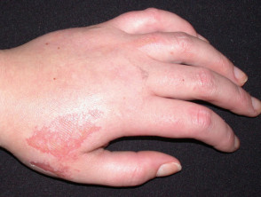 sulfuric acid on skin treatment