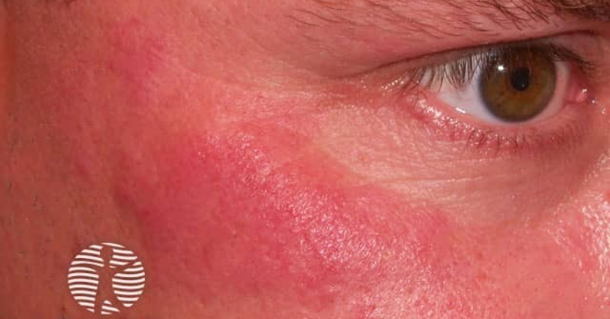Drug induced cutaneous lupus erythematosus image