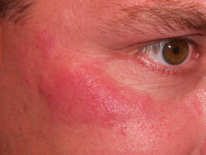 Skin Signs Of Rheumatic Disease Dermnet Nz