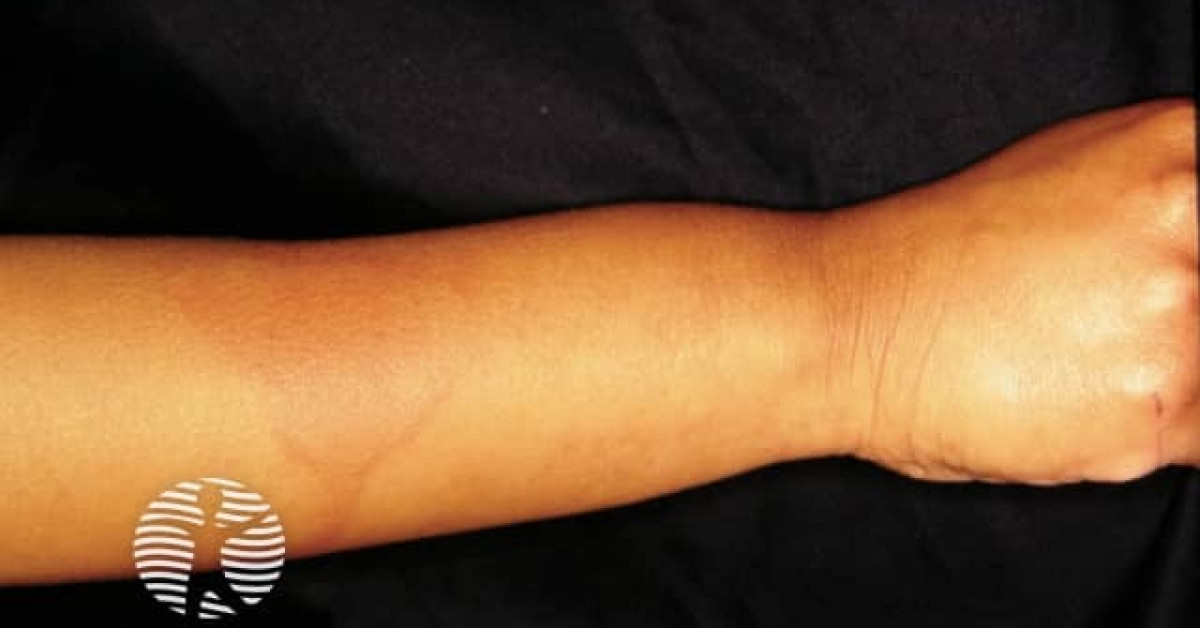 Cold Urticaria Image Cold Urticaria Image