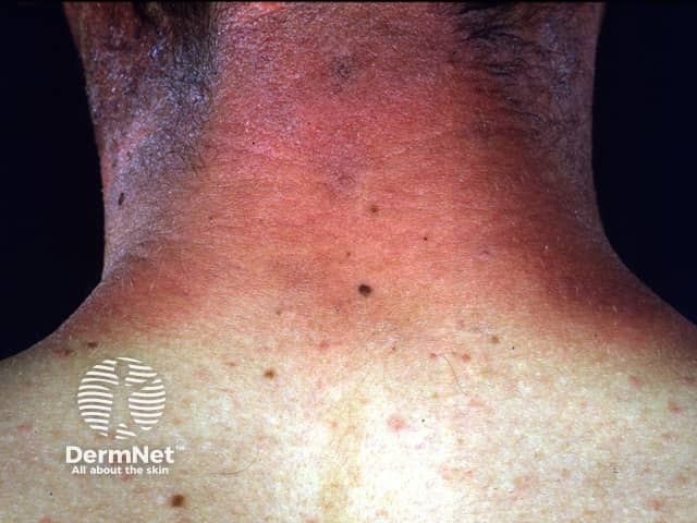 Photoallergic contact dermatitis due to a chemical sunscreen