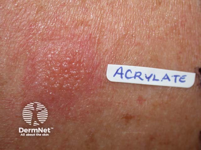 Positive patch test to acrylate