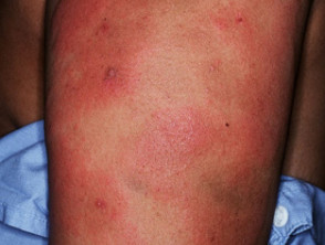 Dermal contact dermatitis