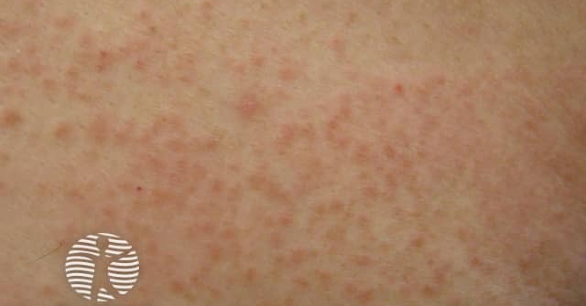 Dermal contact dermatitis image