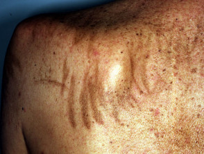 Pigmented streaks caused by bleomycin