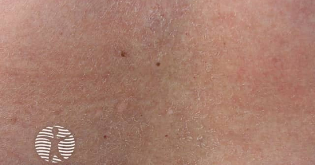 Dry skin image