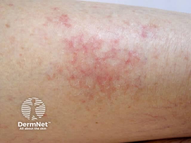 Eczema due to dry skin