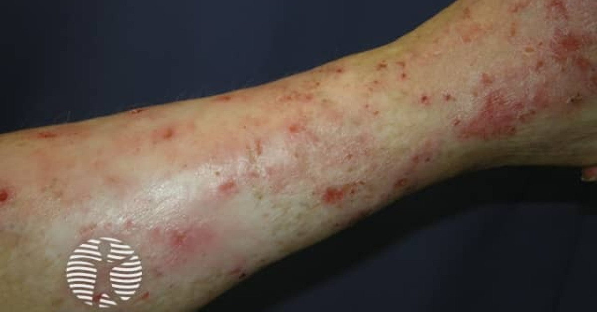 Eczema image